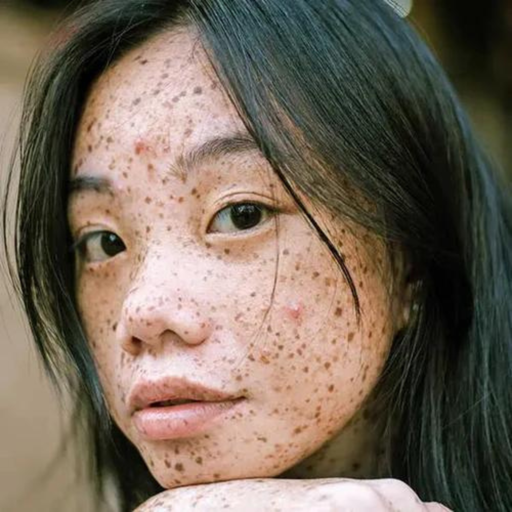How to Manage Acne: Top 10 Tips from a Qualified Skin Scientist